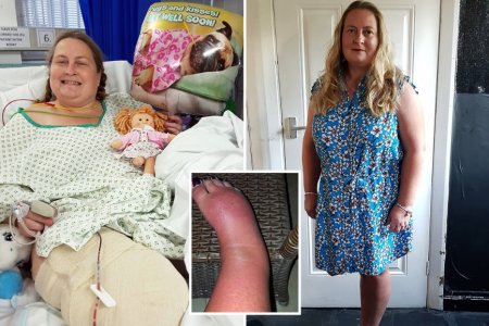 Женщина с синдромом Зудека попросила об ампутации ноги