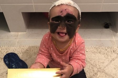 Мама американской девочки с «маской Бэтмена» показала дочь после операции в России