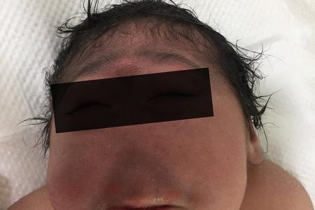 В Ираке родился ребенок без носа