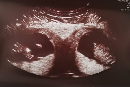 Беременная британка узнала, что ей придется родить дважды