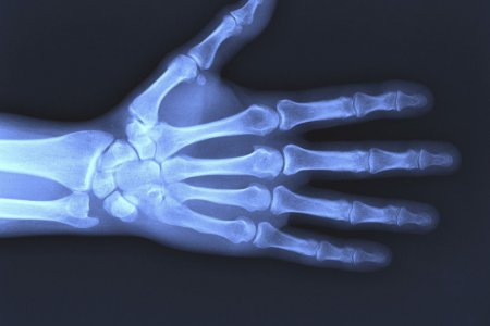 Рак костей: признаки и симптомы