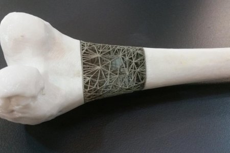 Быстро вылечить сложные переломы костей поможет 3D-печать
