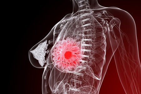 Частые симптомы рака груди, которые могут помочь обнаружить болезнь