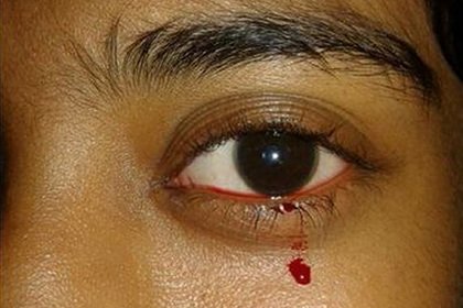 Девочка из Индии вдруг заплакала кровавыми слезами