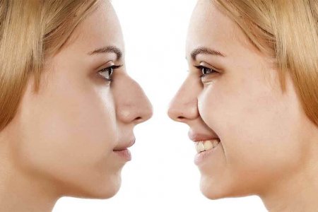 Хирурги научились изменять форму носа пациентам без операции