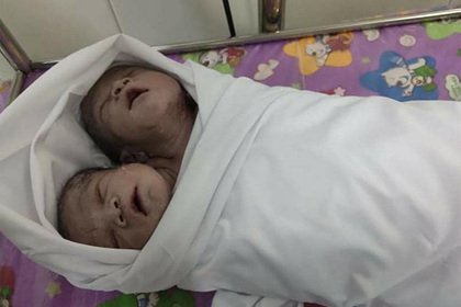 В Мьянме родился здоровый ребенок с двумя головами