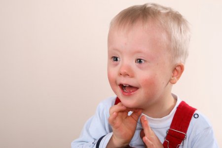 Ученые: черты лица у детей с синдромом Дауна можно изменить без операции
