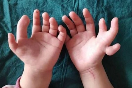 Убрали лишнее: девочке с 14 пальцами провели операцию