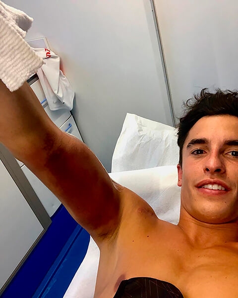 Шестикратный чемпион MotoGP пропустил сезон из-за плохой операции. Хирургам пришлось дважды править сломанную руку