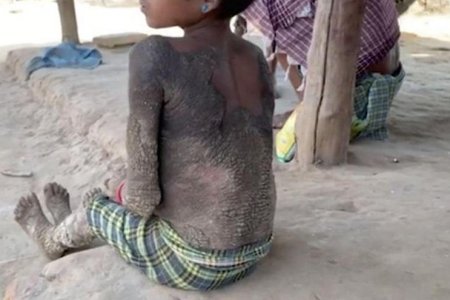 Маленькая девочка из Индии «превращается в камень» из-за редкой болезни